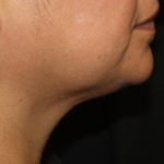 Kybella Before & After Patient #19776