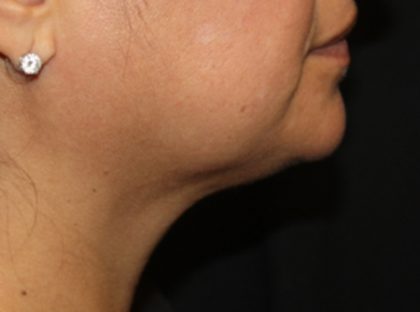 Kybella Before & After Patient #19776