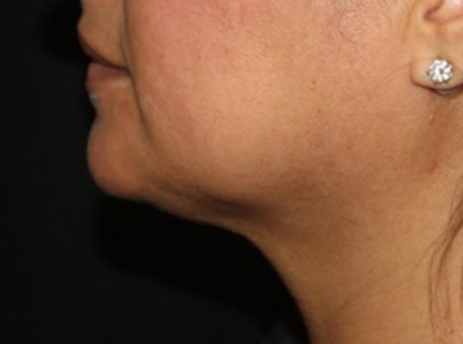 Kybella Before & After Patient #19776