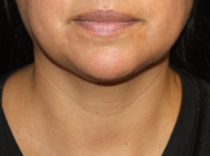 Kybella Before & After Patient #19776