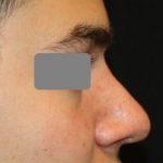 Rhinoplasty Before & After Patient #21714