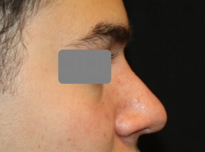 Rhinoplasty Before & After Patient #21714