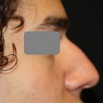 Rhinoplasty Before & After Patient #21714