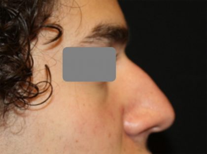 Rhinoplasty Before & After Patient #21714