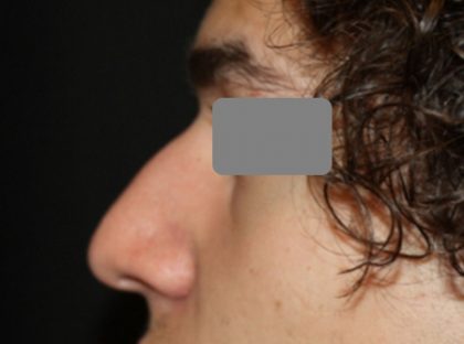 Rhinoplasty Before & After Patient #21714