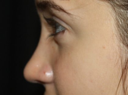 Rhinoplasty Before & After Patient #21726