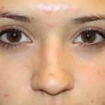 Rhinoplasty Before & After Patient #21726