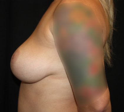 Breast Reduction Before & After Patient #23676