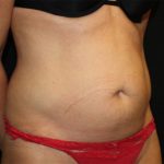 Tummy Tuck Before & After Patient #22717