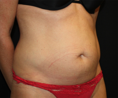 Tummy Tuck Before & After Patient #22717