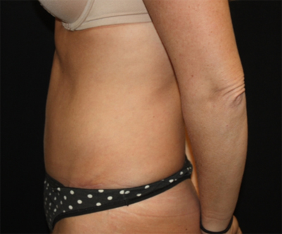 Tummy Tuck Before & After Patient #22717