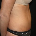 Tummy Tuck Before & After Patient #22717