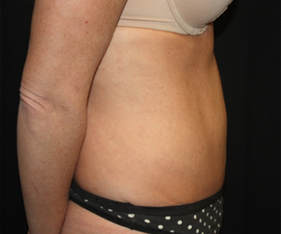 Tummy Tuck Before & After Patient #22717