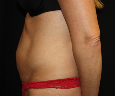 Tummy Tuck Before & After Patient #22717