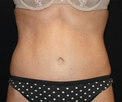 Tummy Tuck Before & After Patient #22717