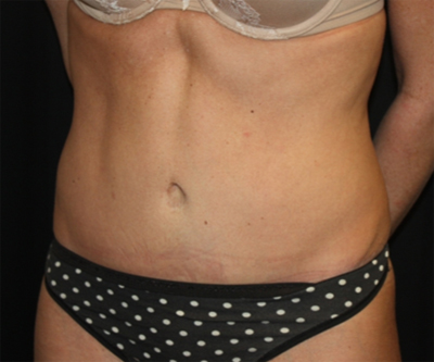 Tummy Tuck Before & After Patient #22717
