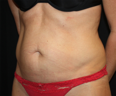 Tummy Tuck Before & After Patient #22717