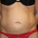 Tummy Tuck Before & After Patient #22717