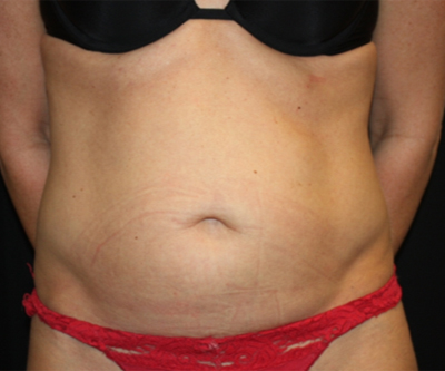 Tummy Tuck Before & After Patient #22717