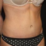 Tummy Tuck Before & After Patient #22717