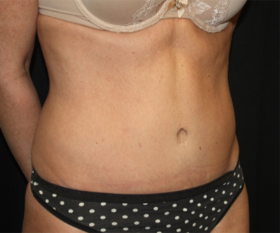 Tummy Tuck Before & After Patient #22717