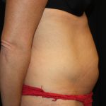 Tummy Tuck Before & After Patient #22717