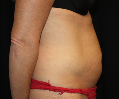 Tummy Tuck Before & After Patient #22717