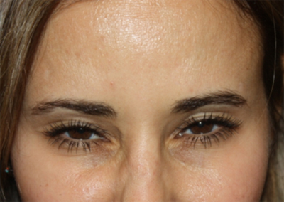 Botox and Dysport Before & After Patient #24759