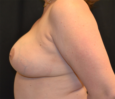 Breast Lift Before & After Patient #20934