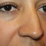 Rhinoplasty Before & After Patient #21736