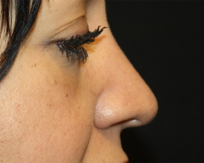 Rhinoplasty Before & After Patient #21736
