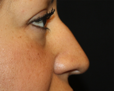 Rhinoplasty Before & After Patient #21736