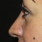 Rhinoplasty Before & After Patient #21736