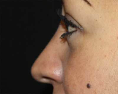 Rhinoplasty Before & After Patient #21736