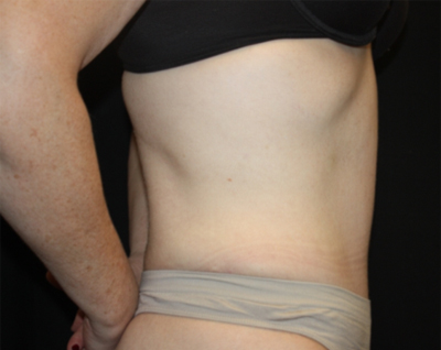 Tummy Tuck Before & After Patient #22744