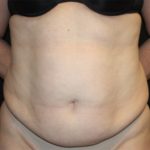 Tummy Tuck Before & After Patient #22744