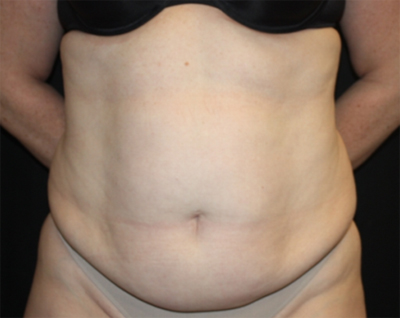 Tummy Tuck Before & After Patient #22744