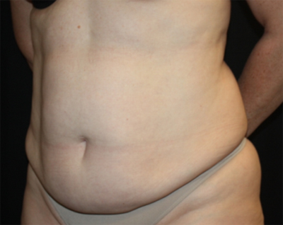 Tummy Tuck Before & After Patient #22744