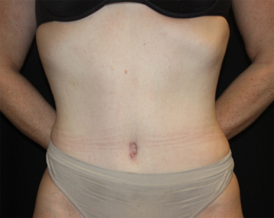 Tummy Tuck Before & After Patient #22744