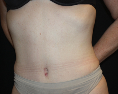 Tummy Tuck Before & After Patient #22744