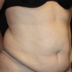 Tummy Tuck Before & After Patient #22744