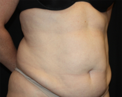 Tummy Tuck Before & After Patient #22744