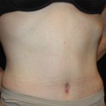 Tummy Tuck Before & After Patient #22744