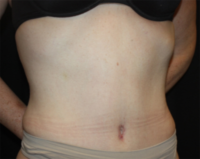 Tummy Tuck Before & After Patient #22744