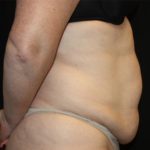 Tummy Tuck Before & After Patient #22744