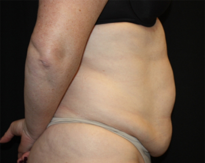 Tummy Tuck Before & After Patient #22744