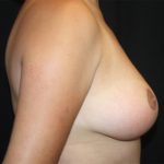 Breast Lift Before & After Patient #20956