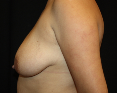 Breast Lift Before & After Patient #20956