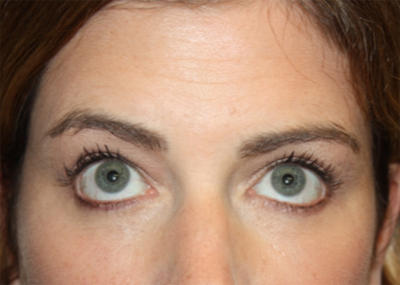 Blepharoplasty and Brow Lift Before & After Patient #20243