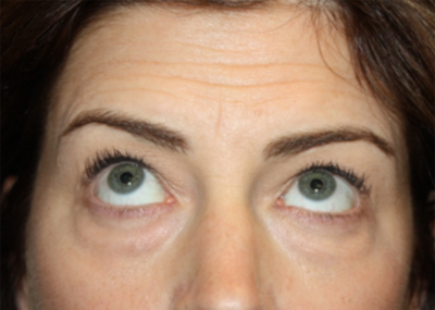 Blepharoplasty and Brow Lift Before & After Patient #20243